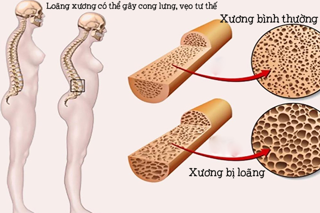 LOÃNG XƯƠNG VÀ TƯ THẾ